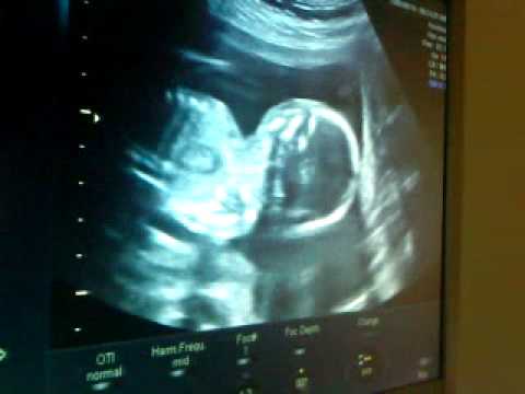 Ultraljud vecka 18
