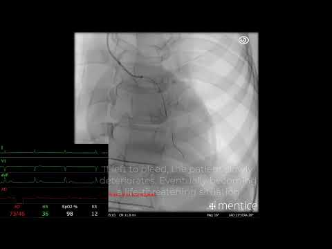 Mentice Coronary Advanced -  Perforation Case