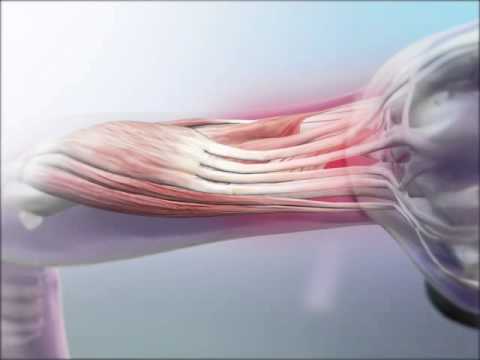 Lateral Epicondylitis: Learn@Visible Body