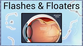 Flashes &amp; Floaters - A Sign of Retinal Detachment