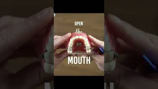 How to do turns on your expander - Braces 101 w/ TheBracesDoc