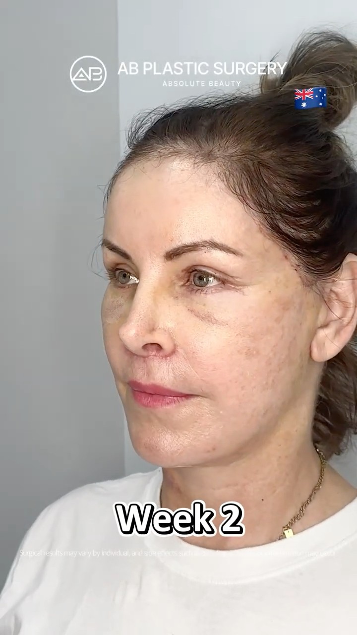 Her Youthful Transformation After Lower Blepharoplasty, Neck Lift & Fat Grafting