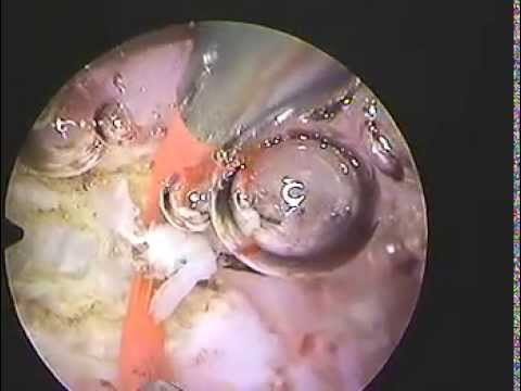 comment traiter un fibrome de 5 cm