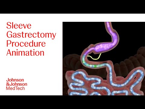 Sleeve Gastrectomy Procedure Animation | J&J MedTech
