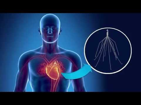 The dangers of IVC filters - and action you can take