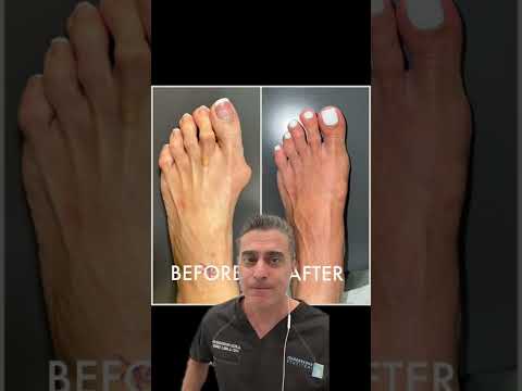 EXPLAINED: Why Bunion Correctors Are A SCAM