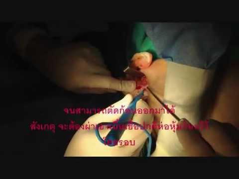 หน้าอกที่เล็กที่สุดในฮอลลีวู้ด หน้าอกพลาสติกเซนต์ปีเตอร์สเบิร์ก
