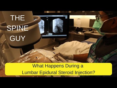 , title : 'What Happens During a Lumbar Epidural Steroid Injection?'