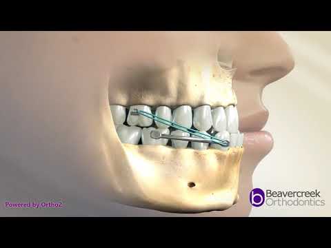 Carriere Distalizers Correcting Underbites and Class 3 Malocclusions