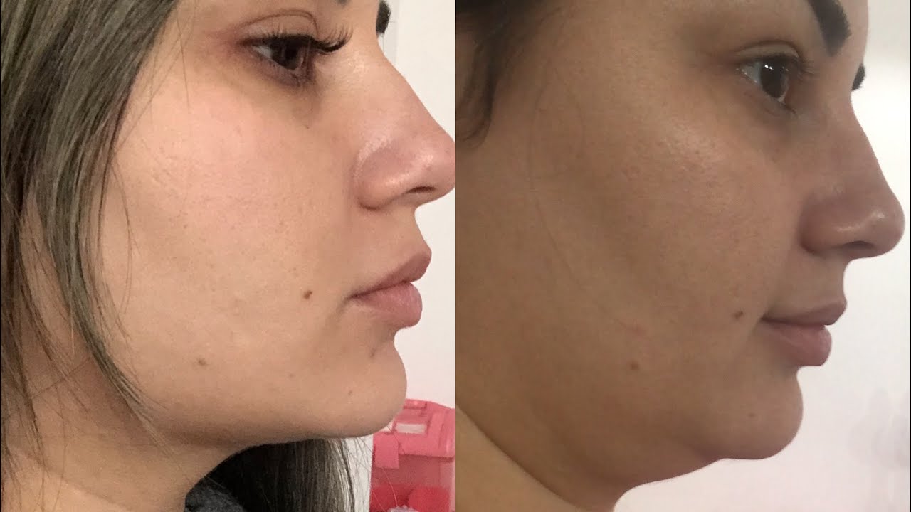 Vlog: tudo sobre Lipo de papada - antes durante e depois