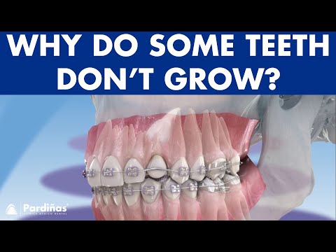 IMPACTED TOOTH - What to do when permanent teeth don't grow ©
