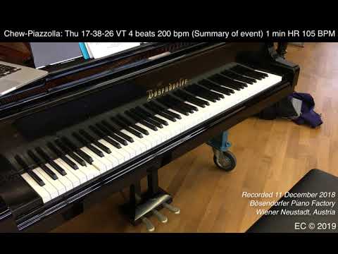 Chew-Piazzolla (2): Thu 17-38-26 VT 4 beats 200 bpm (Summary of event) 1 min HR 105 BPM