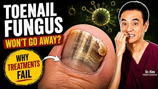 Your Toenail Fungus Keeps Coming Back... Here's Why