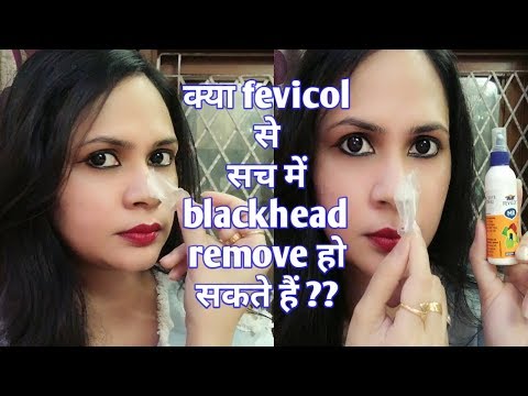 Fevicol से blackheads कैसे निकलते हैं | how to remove blackheads with fevicol Video