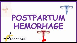 Postpartum Hemorrhage (PPH) causes,risk factors,prevention and treatment