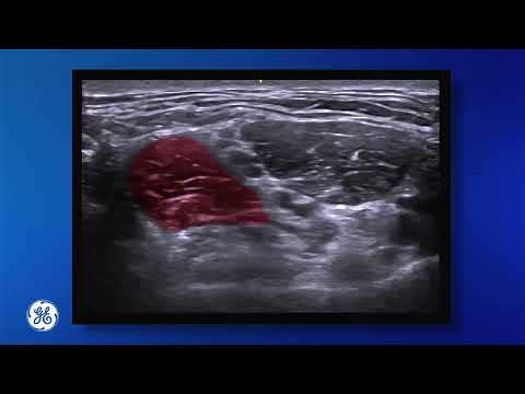 Venue Family |  Brachial Plexus Block in Interscalene Approach