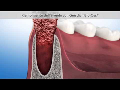 Artrosi delle immagini del ginocchio Camminare sui tacchi a osteocondrosi