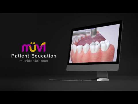 Close More Cases with MÜVI Patient Education