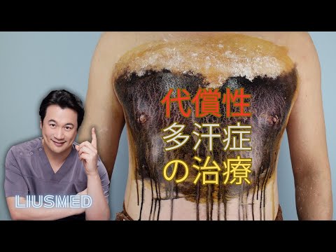 代償性多汗症の治療：非侵襲的な熱分解技術