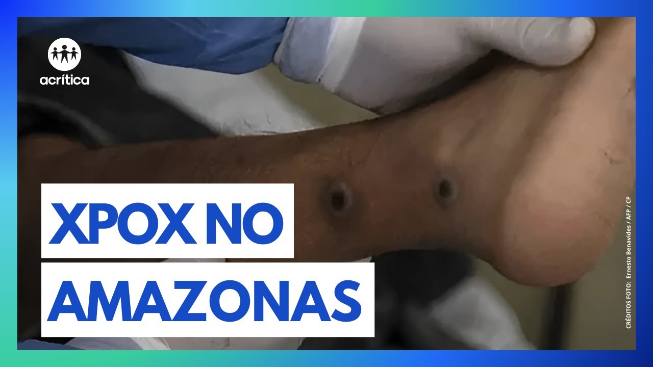CASOS DE MPOX CAEM 56% NO AMAZONAS EM 2025