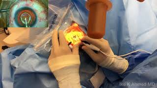 Video: Dr. Ike Ahmed performs a capsulotomy using the Zepto® precision capsulotomy system. Video 2 of 2