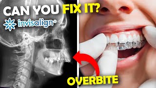 Can Invisalign FIX an Overbite?... Orthodontist Explains
