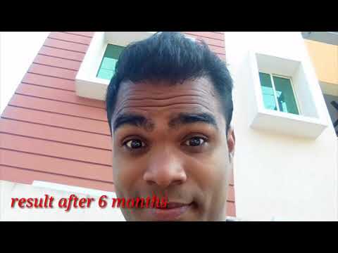 HAIR TRANSPLANT - RESULT AT hairfree & hairgrow clinic, why HFHG BEST ?