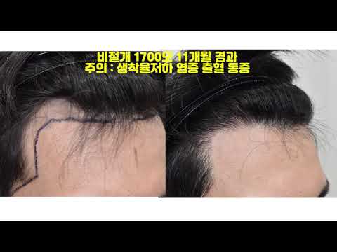 367번 헤어라인 비절개 1700 모발이식