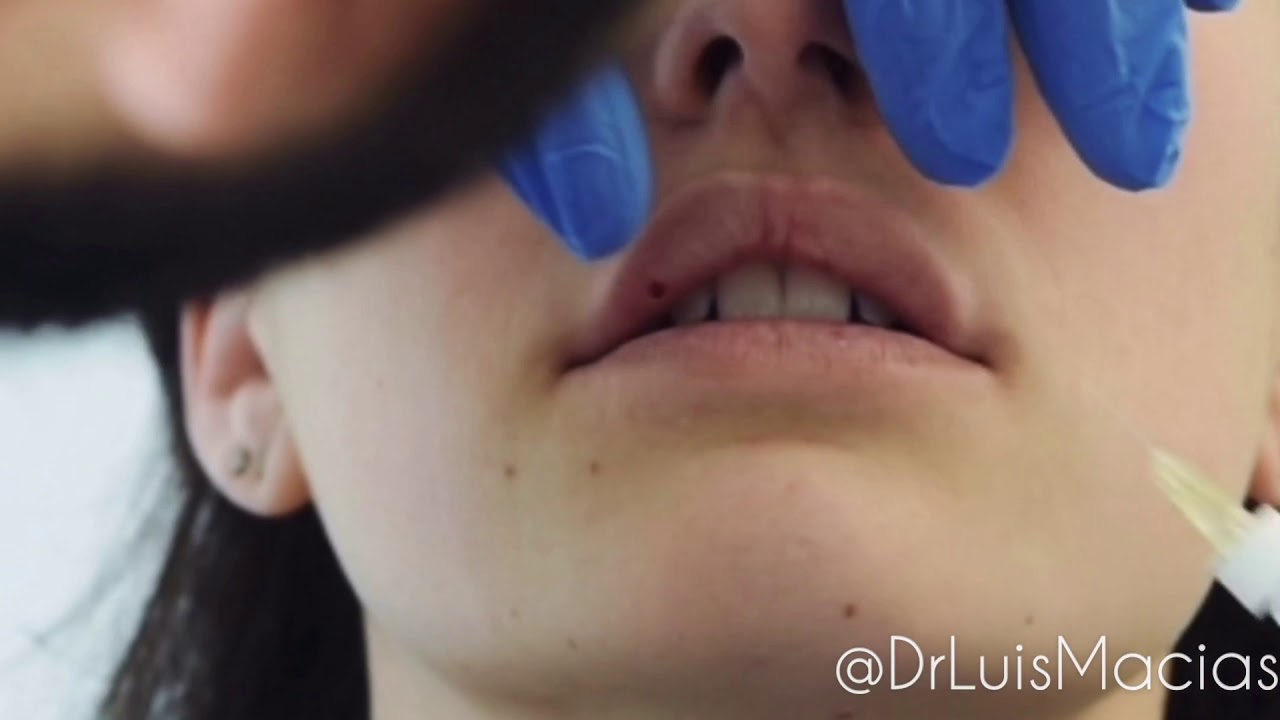 Dr. Macias performing Lip Fillers with Juvederm