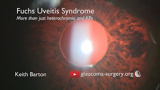 Fuchs Uveitis Syndrome