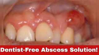 5 Simple Tricks: How to Get Rid of a Tooth Abscess Without Going to the Dentist!