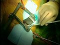 Concomitant Epicardial Ablation In Minimally Invasive Mitral Valve Repair