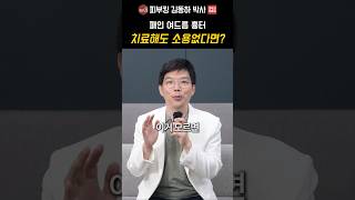 여드름 흉터 레이저 반복 치료에도 효과가 적은 이유: '캐뉼라 서브시전'의 역할
