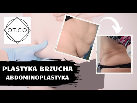 Płaski Brzuch, czyli Abdominoplastyka, na czym polega zabieg - OT.CO Clinic
