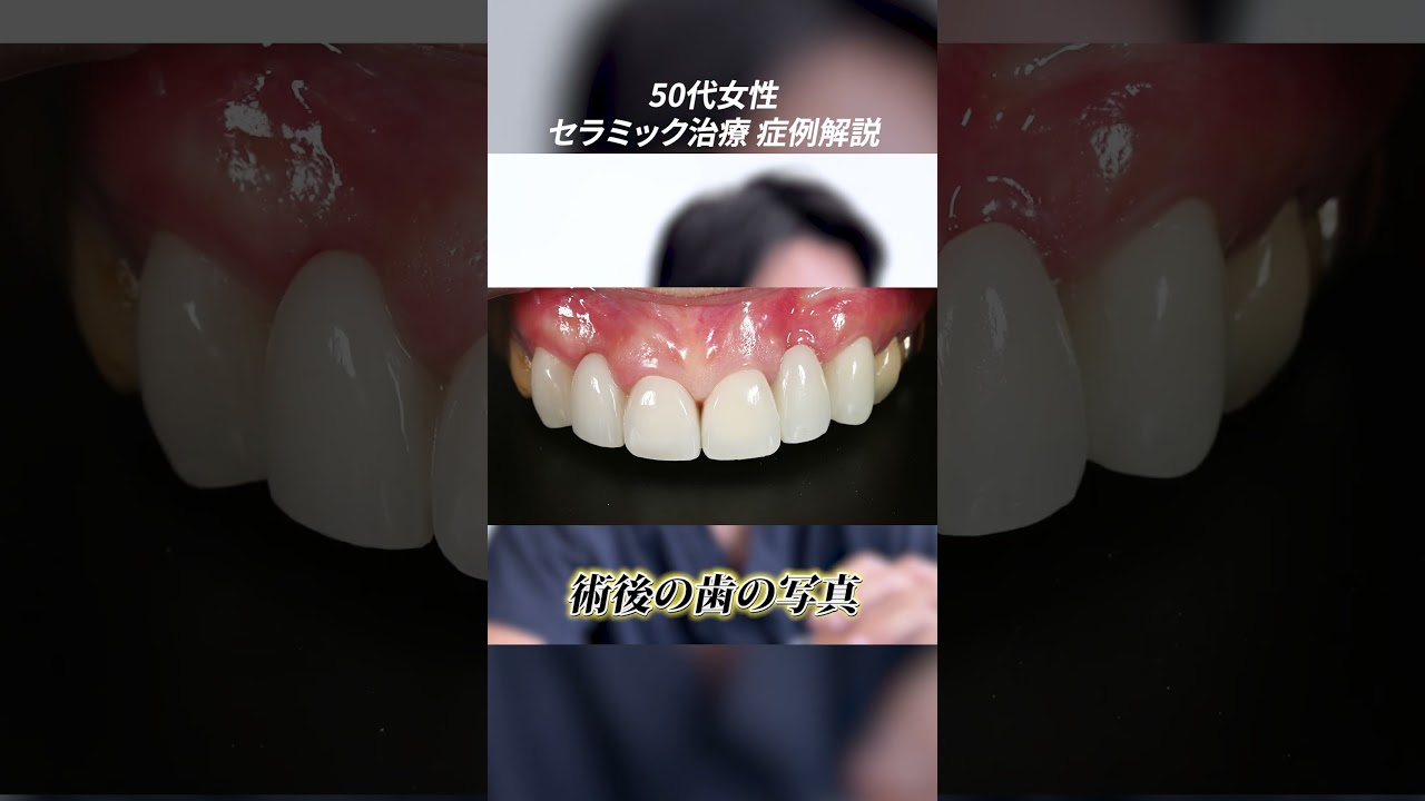 歯が割れて無くなっても大丈夫ですか？50代女性の悩みをセラミック治療で解決【セラミック症例解説】