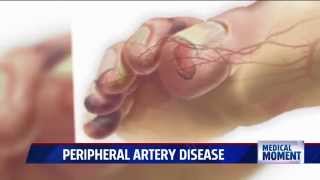 Symptoms and Treatments for Peripheral Artery Disease (PAD)