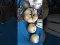 Cavity Design For Composite Restoration Cavity Caries Restoration Composite Teethwhitening