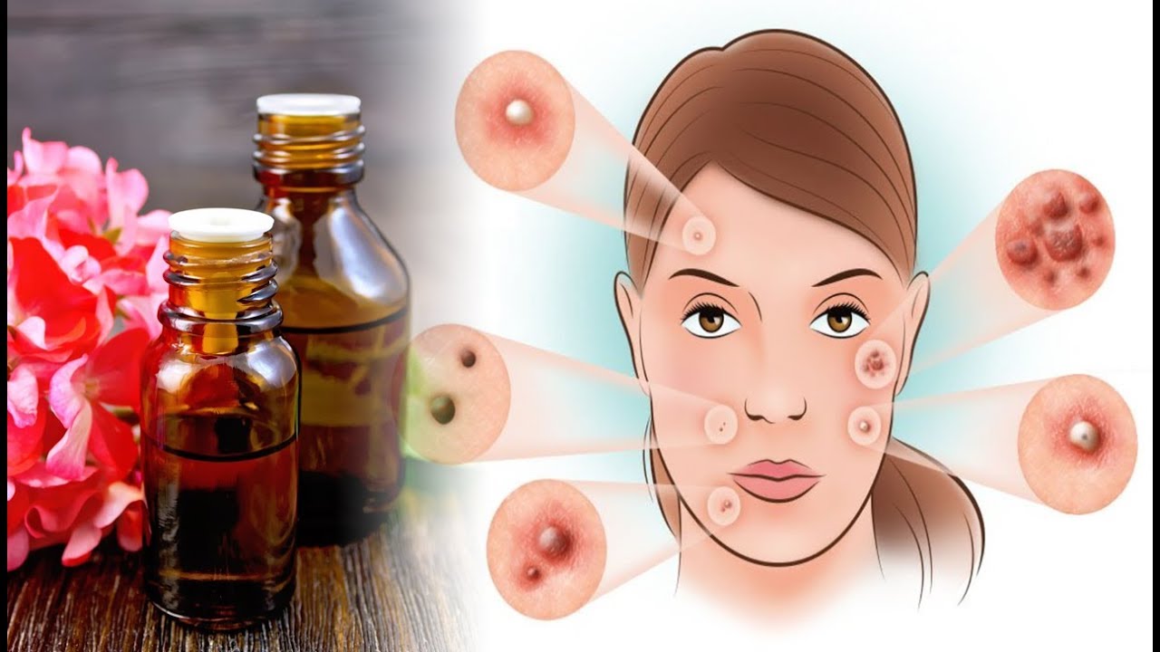 6 Incredible Benefits of Geranium Essential Oil - YouTube