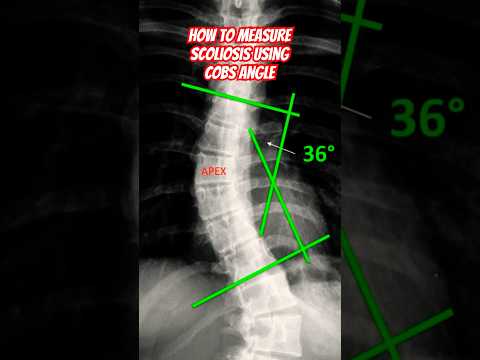 How to Measure Scoliosis 📐#howto #shorts #doctor #health