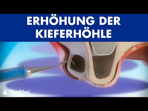 Erhöhung der Kieferhöhle ©