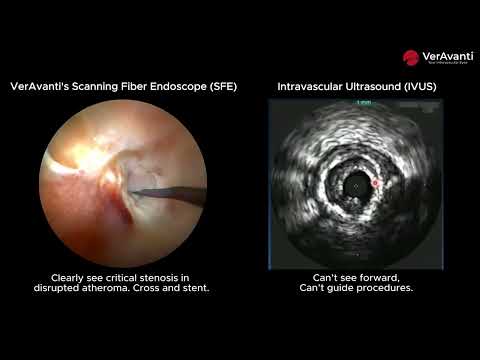 Beyond IVUS: VerAvanti's Forward-Looking SFE for CTO Heart Procedures