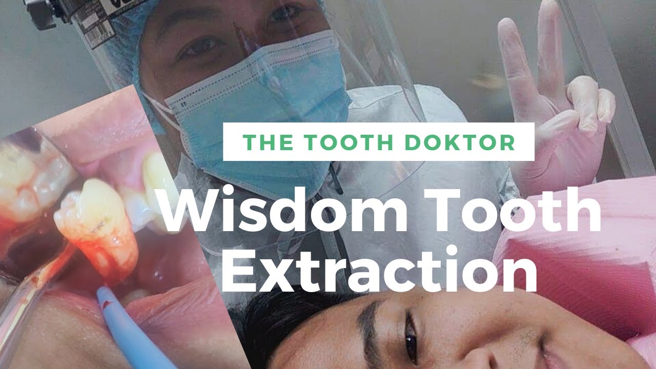 Putar video Wisdom Tooth Extraction In 5 MIN I Ano Ang Dapat Gawin Pagkatapos Bunutan ng Ngipin by Doc Krys 💙 sekarang Wisdom Tooth Extraction In 5 MIN I Ano Ang Dapat Gawin Pagkatapos Bunutan ng Ngipin by Doc Krys 💙