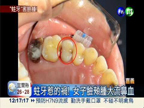 蛀牙誤敏感 臉腫蜂窩性組織炎