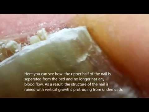 Halamang-singaw kuko sa paa Uri at Paggamot Candida kuko halamang-singaw