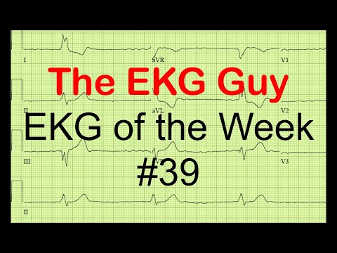 EKG/ECG of the Week #39 | The EKG Guy - www.ekg.md