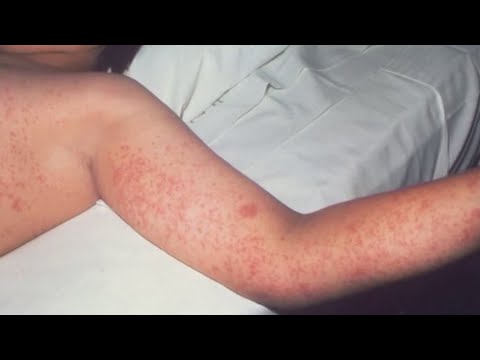 Measles outbreaks threaten to end the US's disease-free status