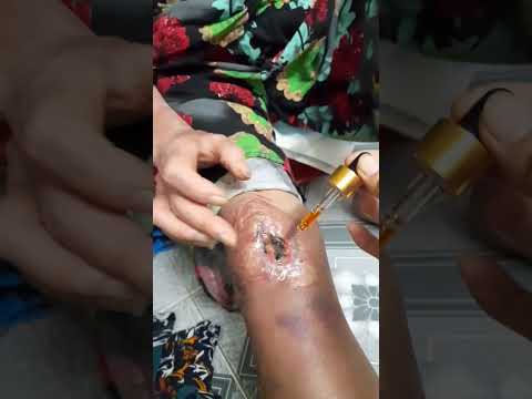 Hoại Tử Do Tiểu Đường, nằm lâu ngày