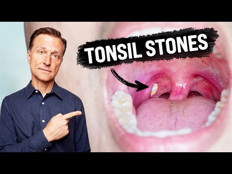 Shingles Natural Relief