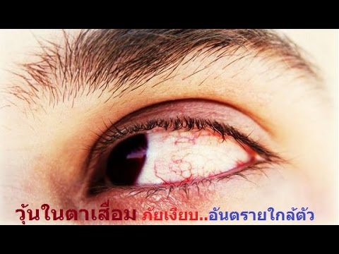 ครีม chagoy สำหรับโรคสะเก็ดเงิน โรคสะเก็ดเงินที่ขาเวทีภาพเบื้องต้น
