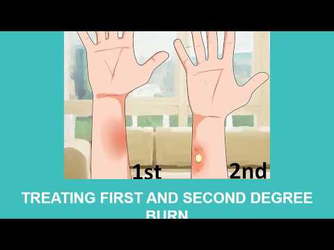 How to treat a burn?